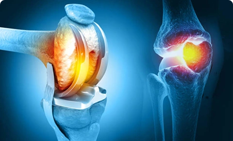 Knee joint comparison showing healthy joint versus arthritic knee with inflammation.
