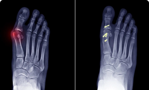 X-ray image of a foot showing bunion deformity before and after correction.