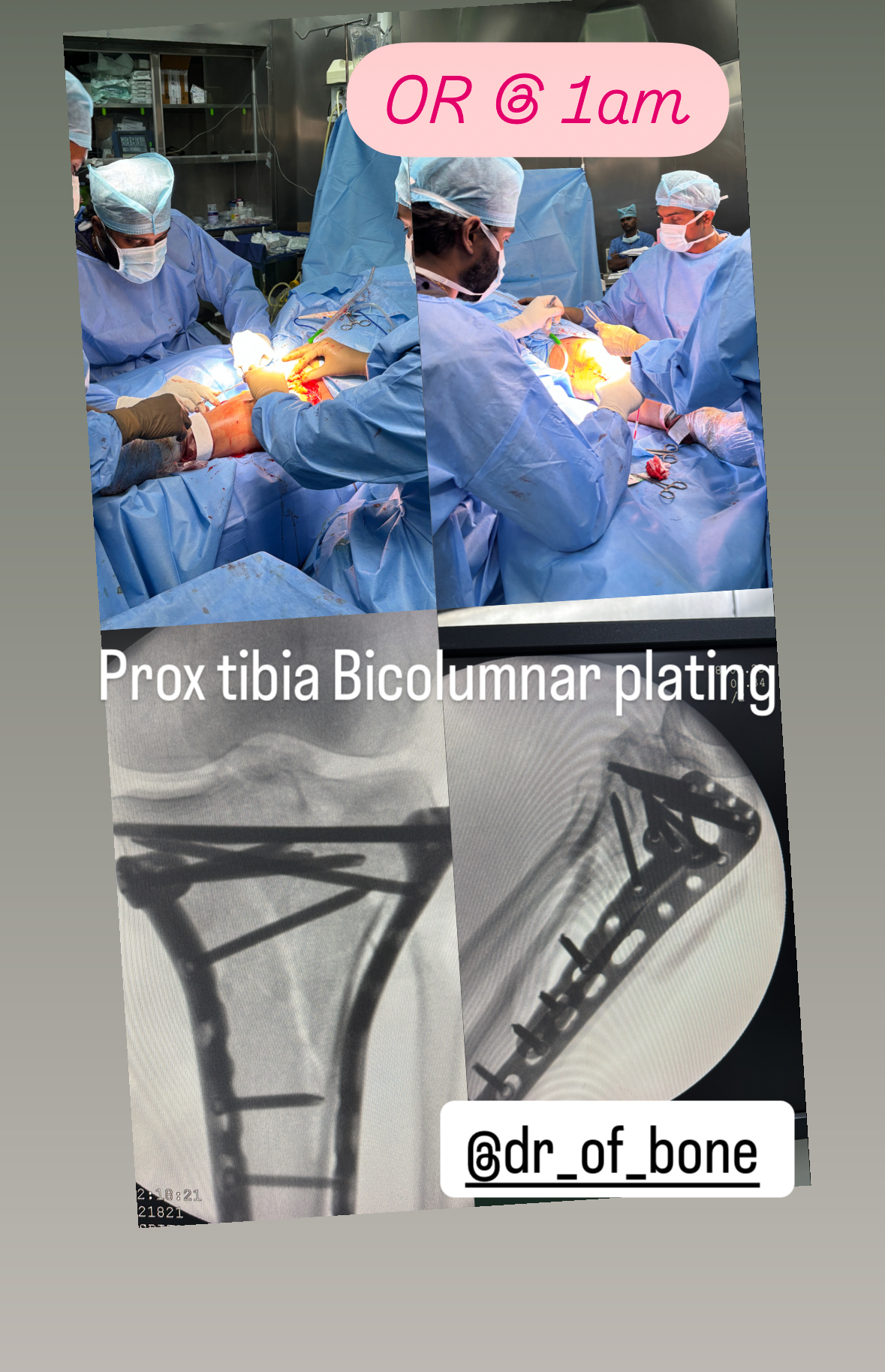 Leg Fracture Plating Procedure at Midnight